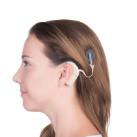Cochlear-Implants