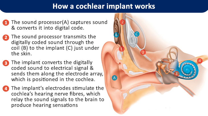 HOW DO COCHLEAR IMPLANTS WORK