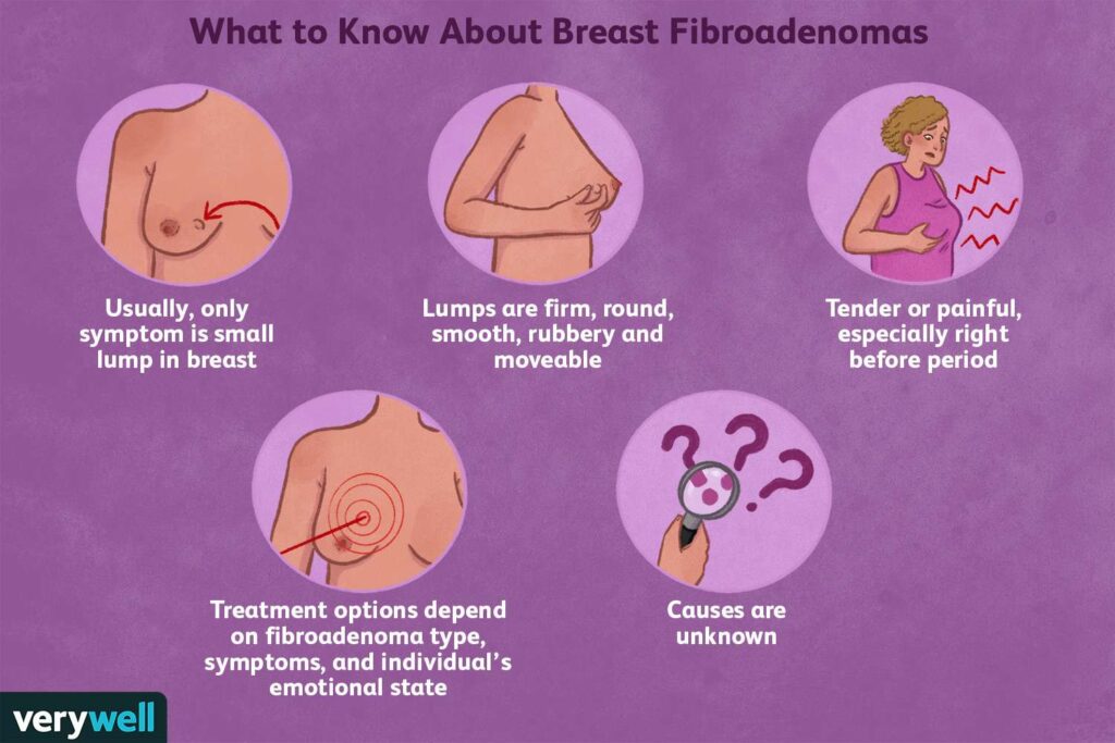 How to Dissolve Fibroadenoma Naturally