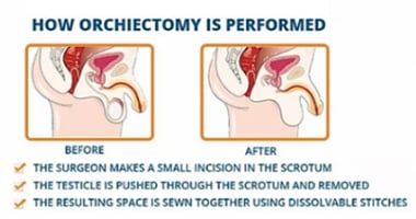 Orchiektomie