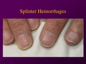 What is Splinter Hemorrhage? Causes, Symptoms, Risks, Treatment