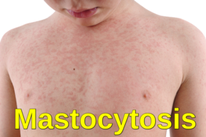 Systemic Mastocytosis