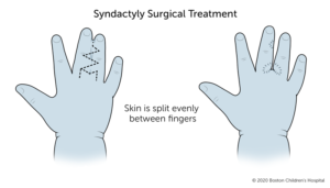 treatment for syndactyly