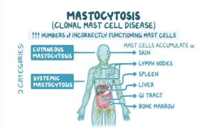 Types of Systemic Mastocytosis