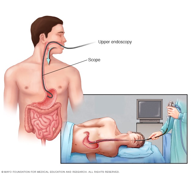 Upper Endoscopy EoE