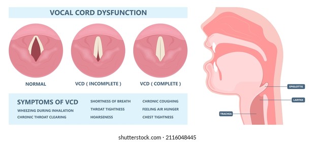 VOCAL CORD DYSFUNCTION SYMPTOMS