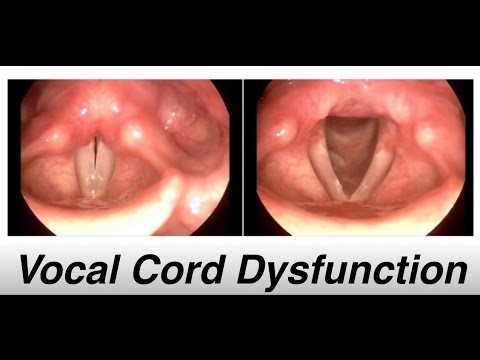WHAT IS VOCAL CORD DYSFUNCTION 