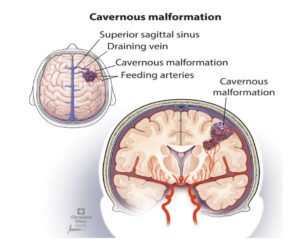 cavernous angioma 