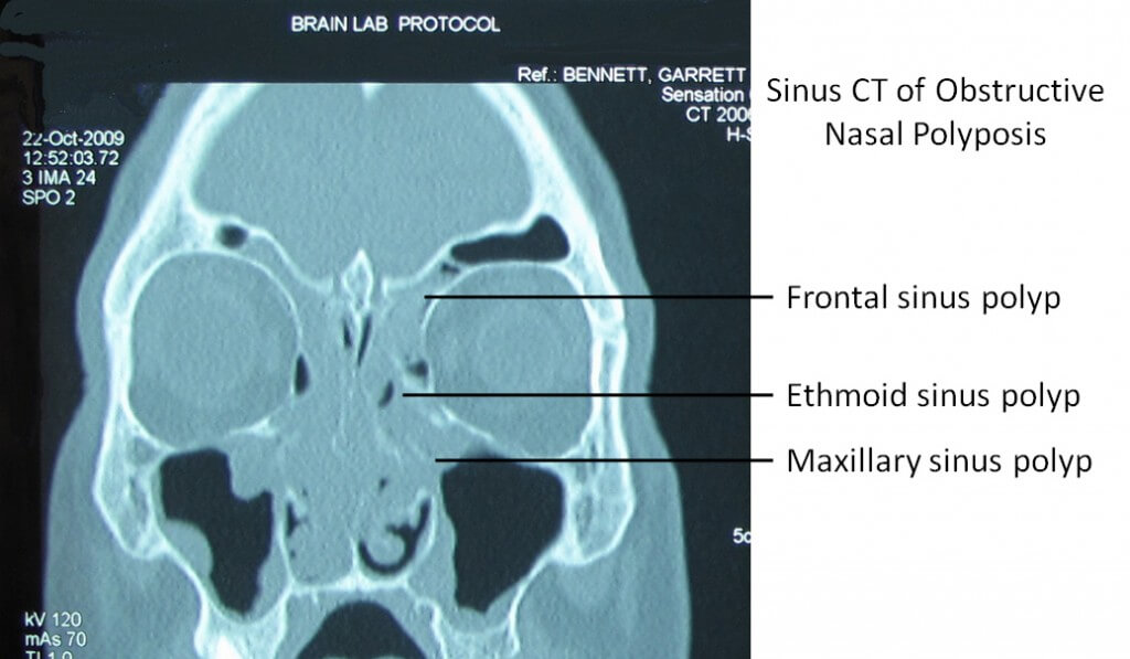 nasal polyps diagnosis imaging tests