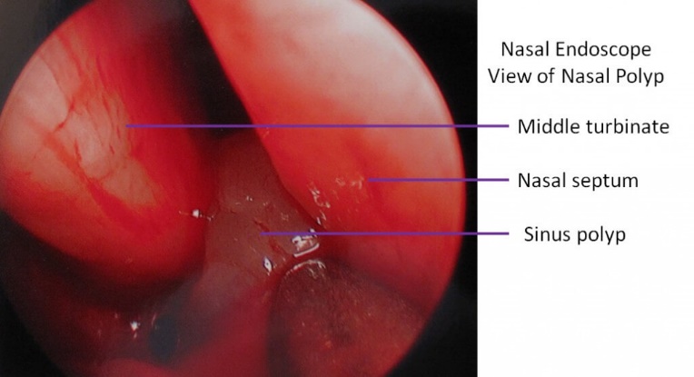 Nasenpolypen Diagnose nasale Endoskopie