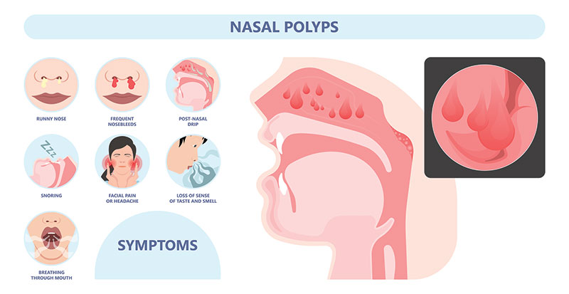 Symptome von Nasenpolypen