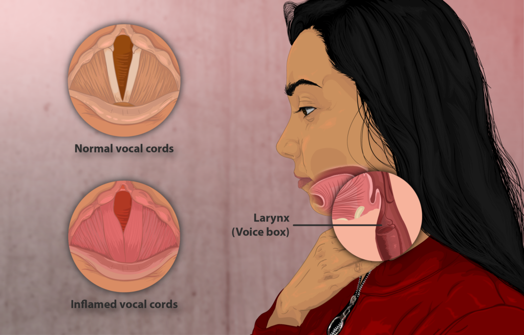 Movimiento paradójico de las cuerdas vocales (PVFM): disfunción de las cuerdas vocales