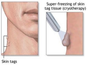 Skin-Tag-Removal-cryotherapy