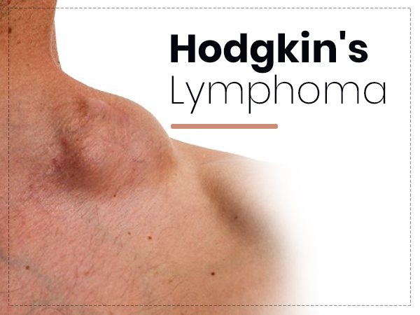 Hodgkin’s Lymphoma