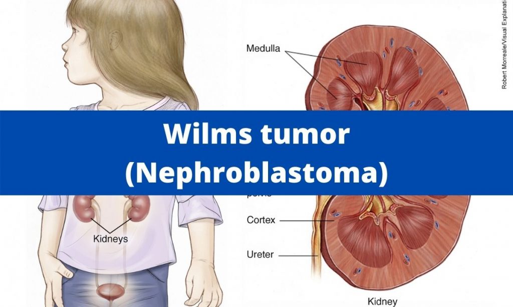 Néphroblastome (tumeur de Wilms)
