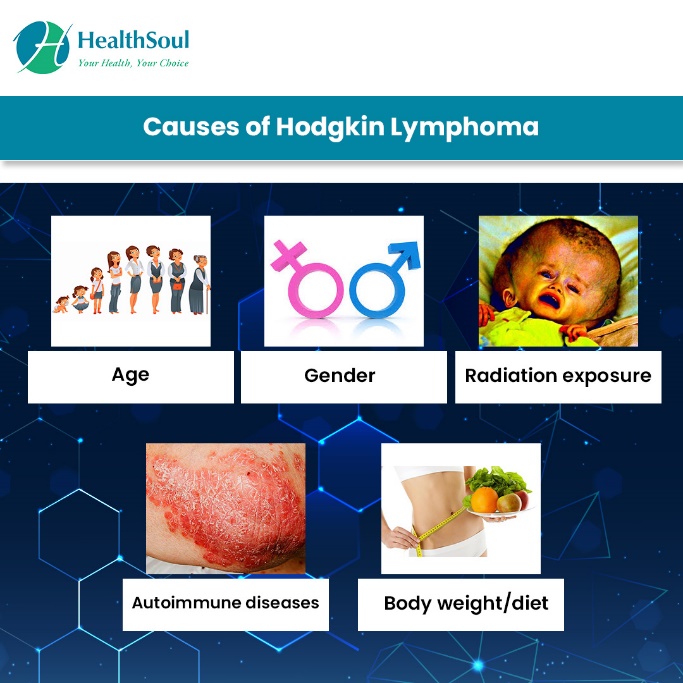 causes of Hodgkin’s lymphoma