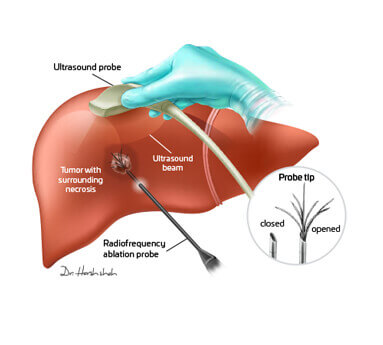Ablation Therapy liver cancer
