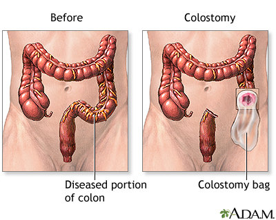 Bowel resection with colostomy