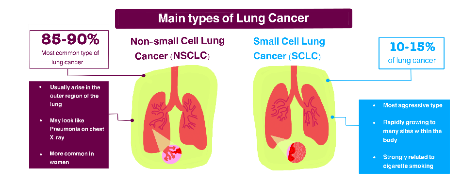 Principales tipos de cáncer de pulmón