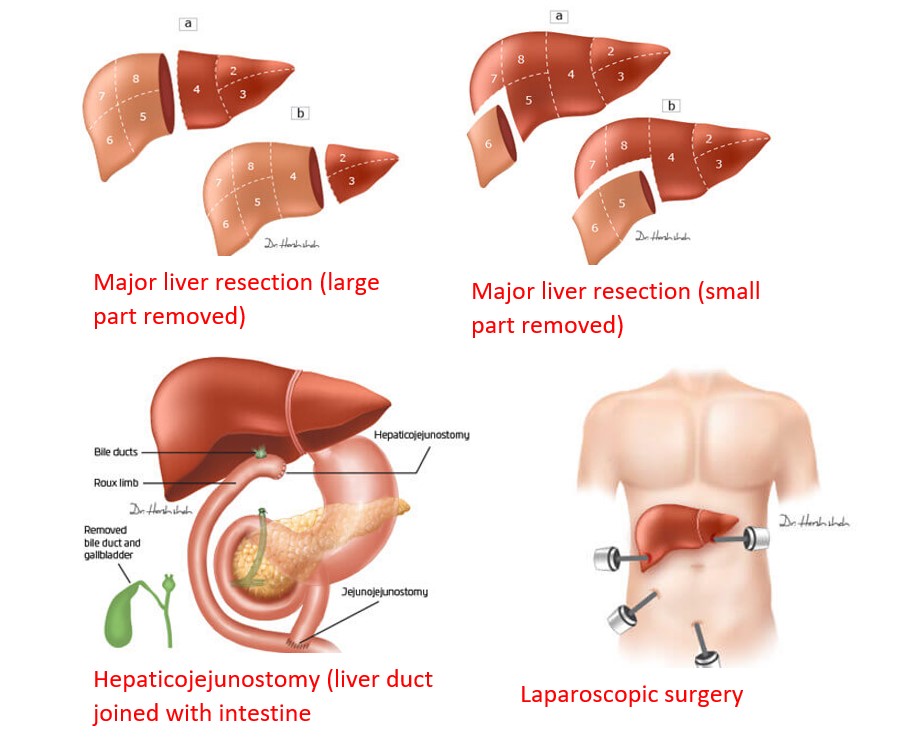 Partial hepatectomy