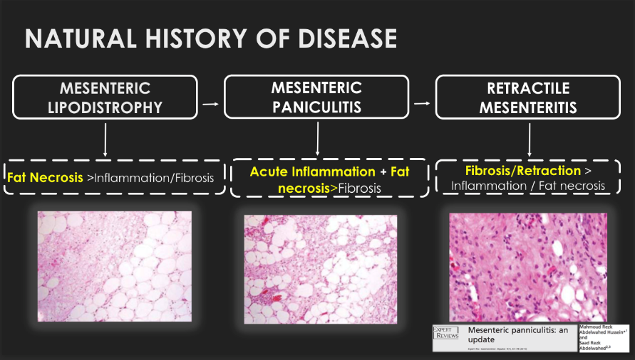 Stages of Mesenteric Panniculitis