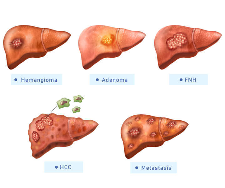 أنواع سرطان الكبد