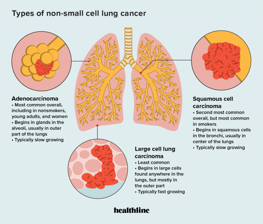 Tipos de cáncer de pulmón