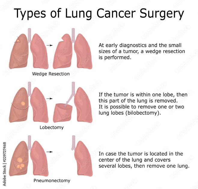 Types of lung cancer surgery
