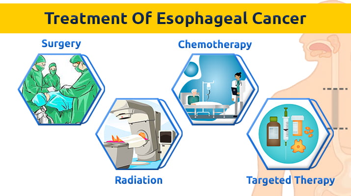 oesophageal cancer treatment