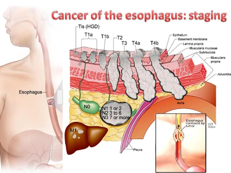 stades du cancer de l'oesophage