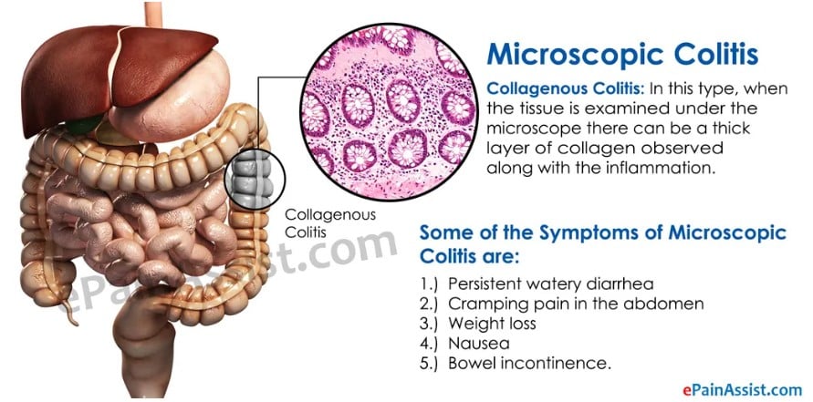 symptoms of microscopic colitis 