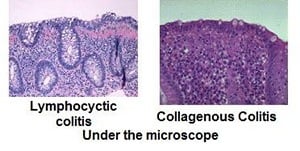 types of Microscopic Colitis