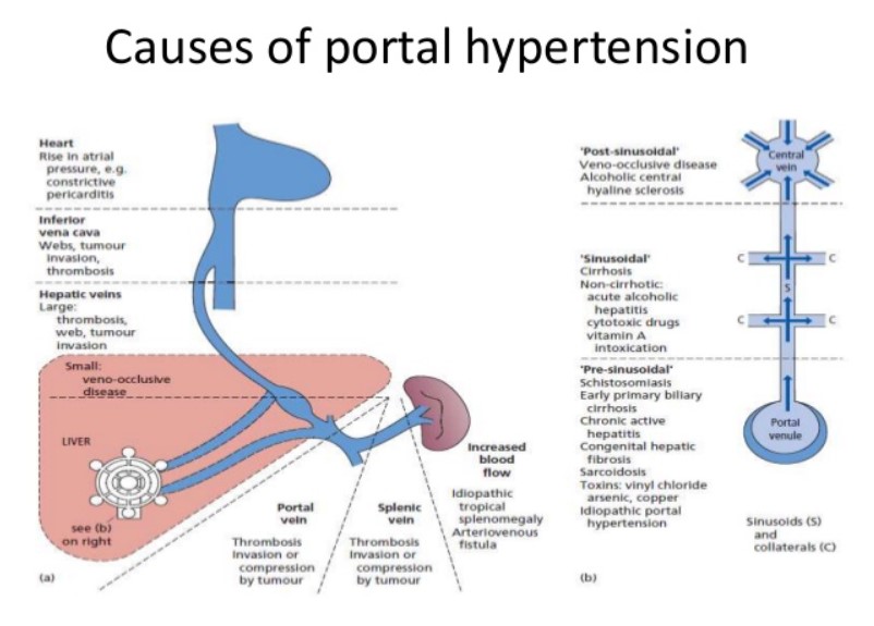 Causes of Portal Hypertension
