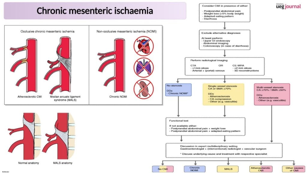 Chronic Mesenteric Ischemia