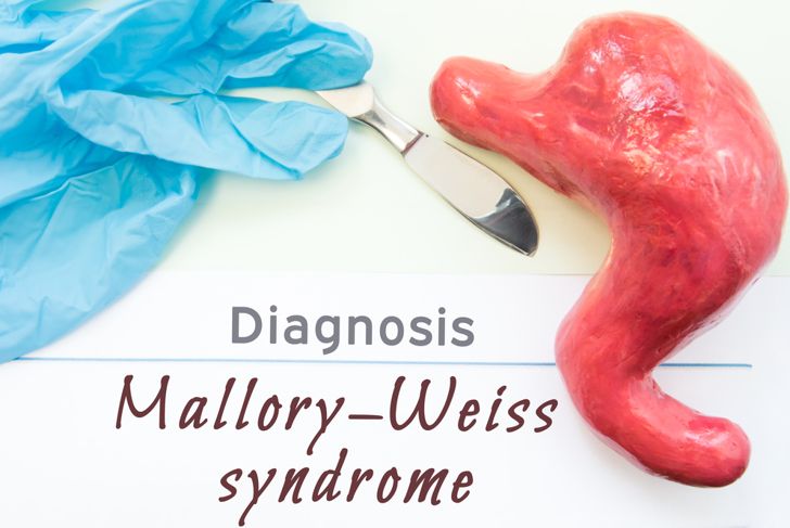 Diagnose des Mallory-Weiss-Syndroms