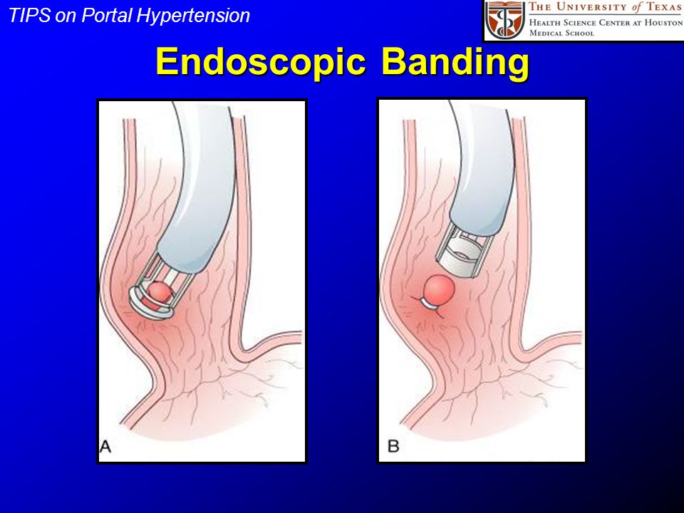 Endoscopic Treatment Portal Hypertension