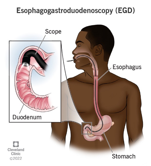 Esophagogastroduodenoscopy or EGD