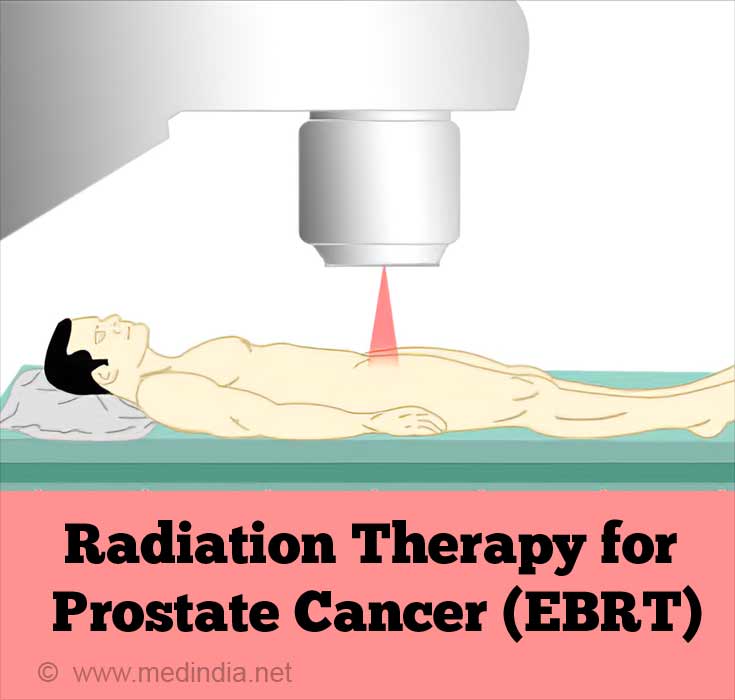 Radiothérapie pour le cancer de la prostate