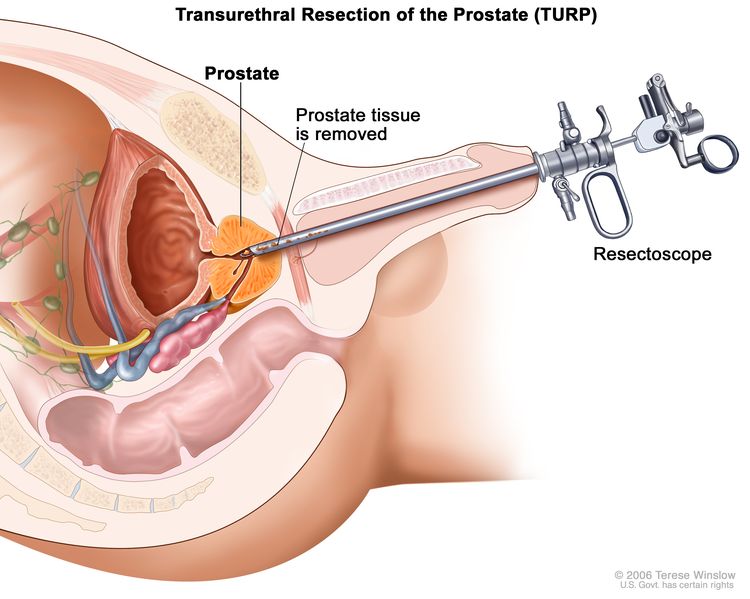Résection transurétrale de la prostate