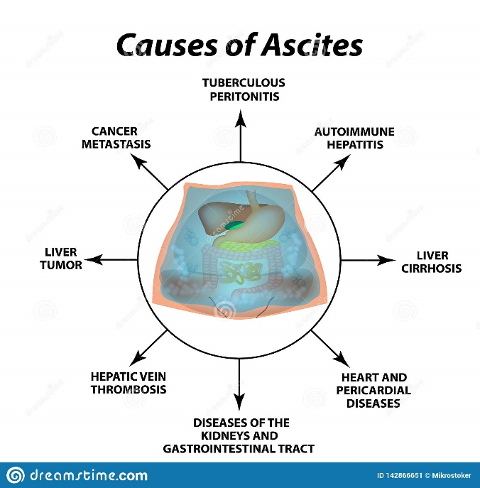 Causes of ascites