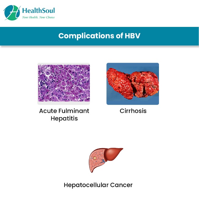 complications of Hepatitis B
