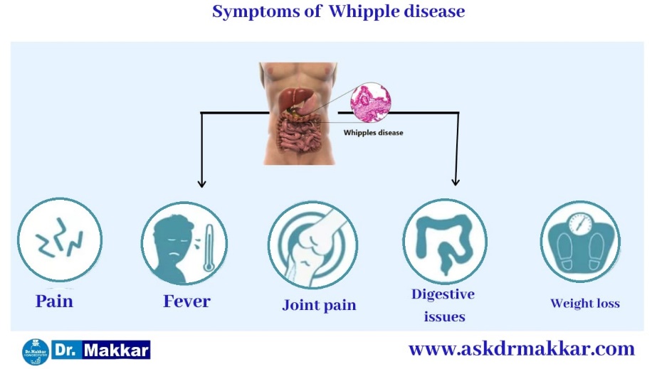 symptoms of Whipple’s disease.jpg