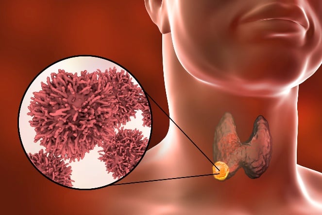 thyroid medullary carcinoma