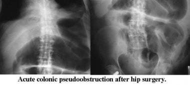 Diagnostic de pseudo-obstruction intestinale
