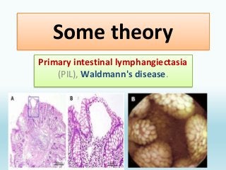 primary intestinal lymphangiectasia