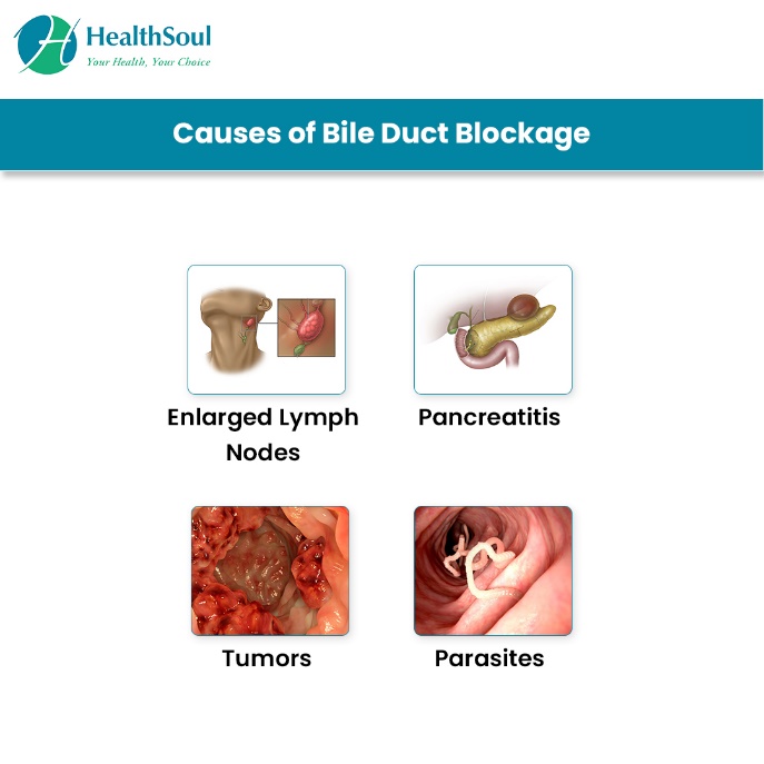 causes of biliary duct blockage