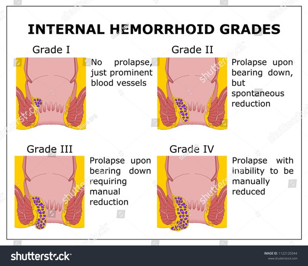 internal hemorrhoids grades