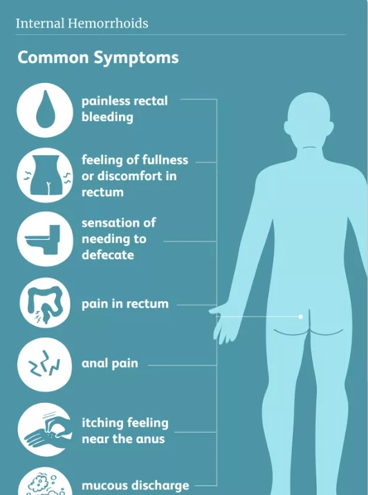Symptome von Hämorrhoiden