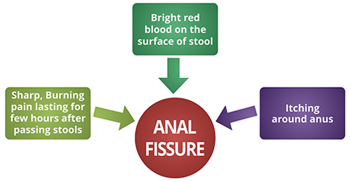 symptoms of anal fissures