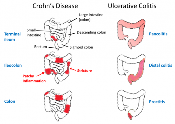 types of inflammatory bowel disease